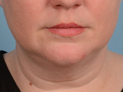 Neck Submental Liposuction Before & After Image