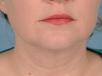 Neck Submental Liposuction Before & After Image