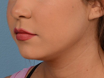 Neck Submental Liposuction Before & After Image