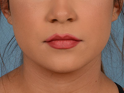 Neck Submental Liposuction Before & After Image