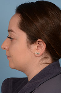 Neck Submental Liposuction Before & After Image