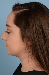 Neck Submental Liposuction Before & After Image