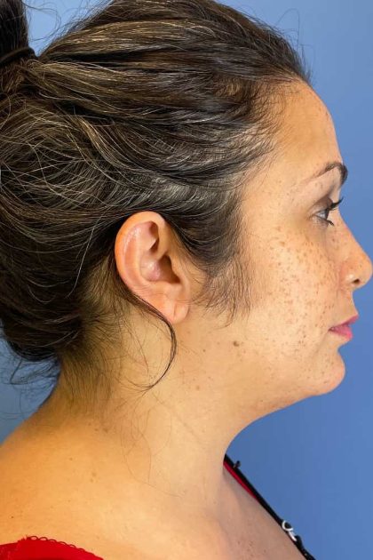 Neck Submental Liposuction Before & After Image