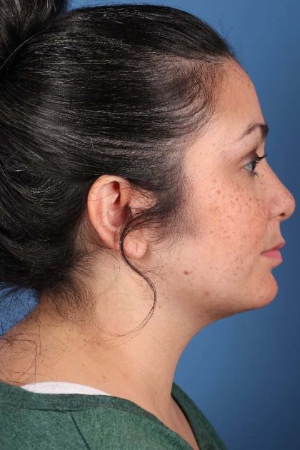 Neck Submental Liposuction Before & After Image