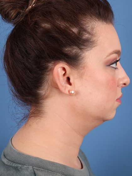 Neck Submental Liposuction Before & After Image