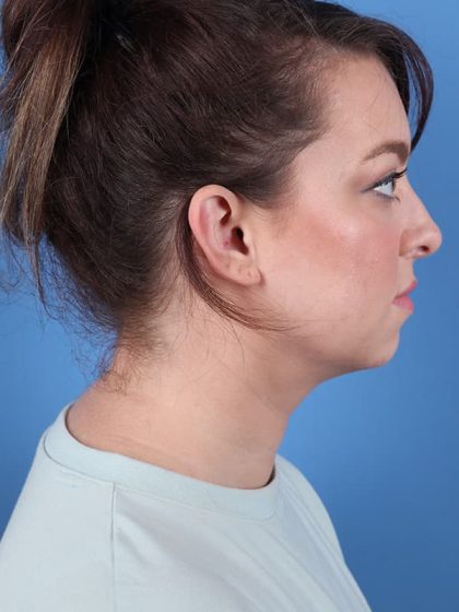 Neck Submental Liposuction Before & After Image