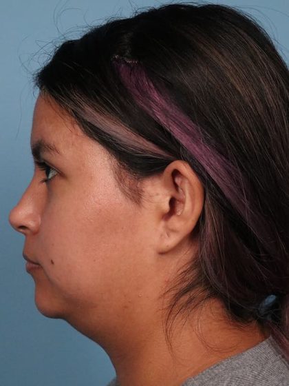 Neck Submental Liposuction Before & After Image