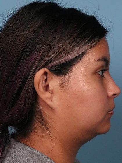 Neck Submental Liposuction Before & After Image