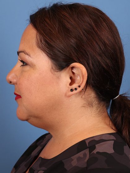 Neck Submental Liposuction Before & After Image