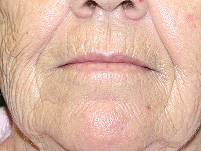 Phenol Peel Before & After Image