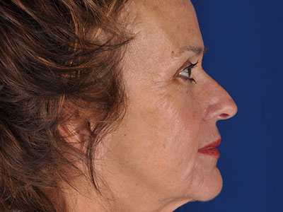 Phenol Peel Before & After Image