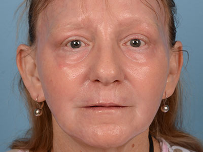 Phenol Peel Before & After Image