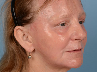 Phenol Peel Before & After Image