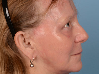 Phenol Peel Before & After Image