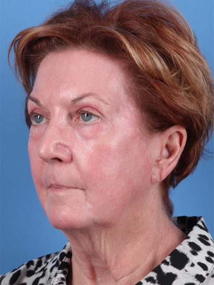 Phenol Peel Before & After Image