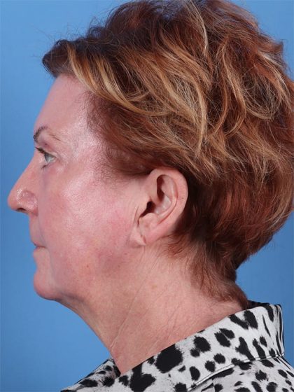 Phenol Peel Before & After Image