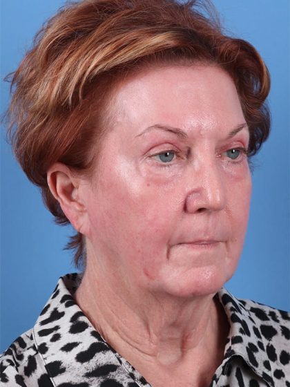 Phenol Peel Before & After Image