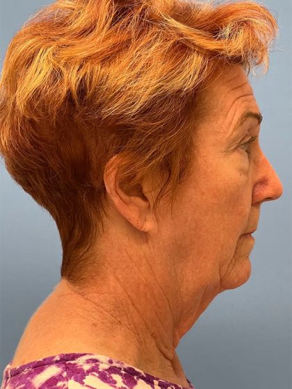 Phenol Peel Before & After Image