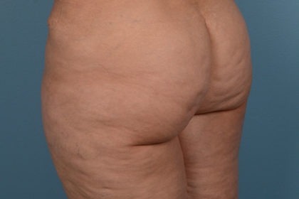 Cellulite Reduction Before & After Image