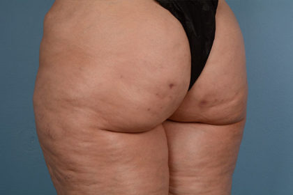 Cellulite Reduction Before & After Image