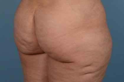 Cellulite Reduction Before & After Image