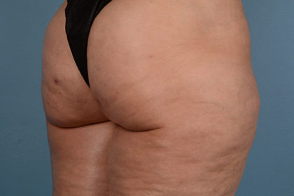 Cellulite Reduction Before & After Image