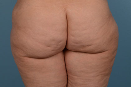 Cellulite Reduction Before & After Image