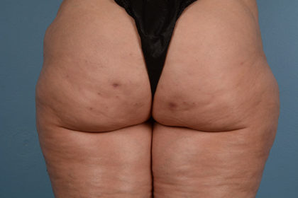 Cellulite Reduction Before & After Image