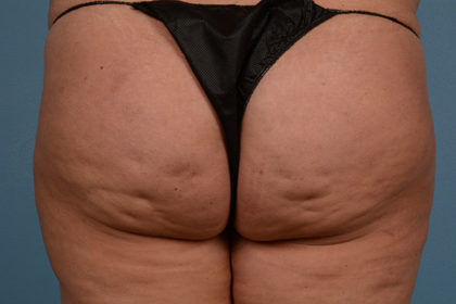 Cellulite Reduction Before & After Image