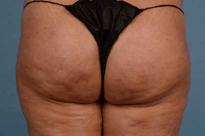 Cellulite Reduction Before & After Image