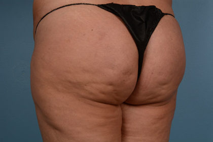 Cellulite Reduction Before & After Image