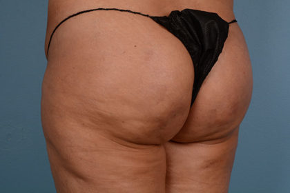 Cellulite Reduction Before & After Image