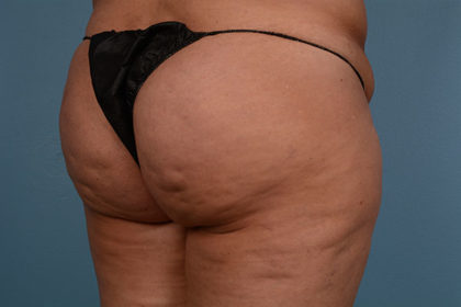 Cellulite Reduction Before & After Image