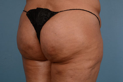 Cellulite Reduction Before & After Image