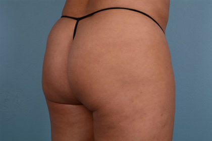 Cellulite Reduction Before & After Image