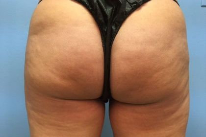 Cellulite Reduction Before & After Image