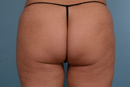 Cellulite Reduction Before & After Image