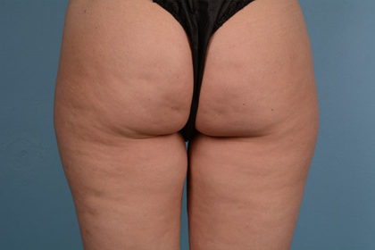 Cellulite Reduction Before & After Image