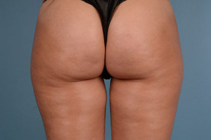 Cellulite Reduction Before & After Image