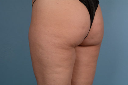 Cellulite Reduction Before & After Image