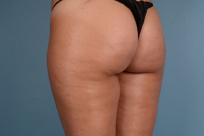 Cellulite Reduction Before & After Image