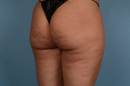 Cellulite Reduction Before & After Image