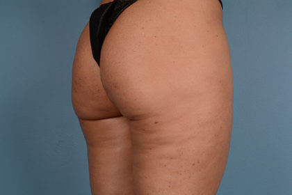 Cellulite Reduction Before & After Image