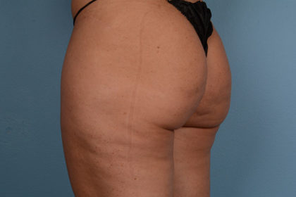 Cellulite Reduction Before & After Image