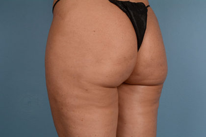 Cellulite Reduction Before & After Image