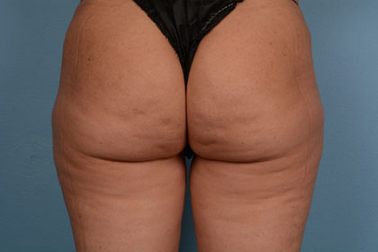 Cellulite Reduction Before & After Image