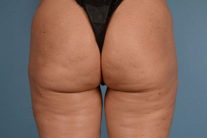 Cellulite Reduction Before & After Image