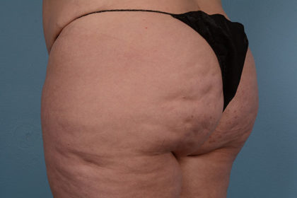 Cellulite Reduction Before & After Image