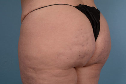 Cellulite Reduction Before & After Image