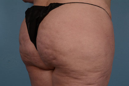 Cellulite Reduction Before & After Image